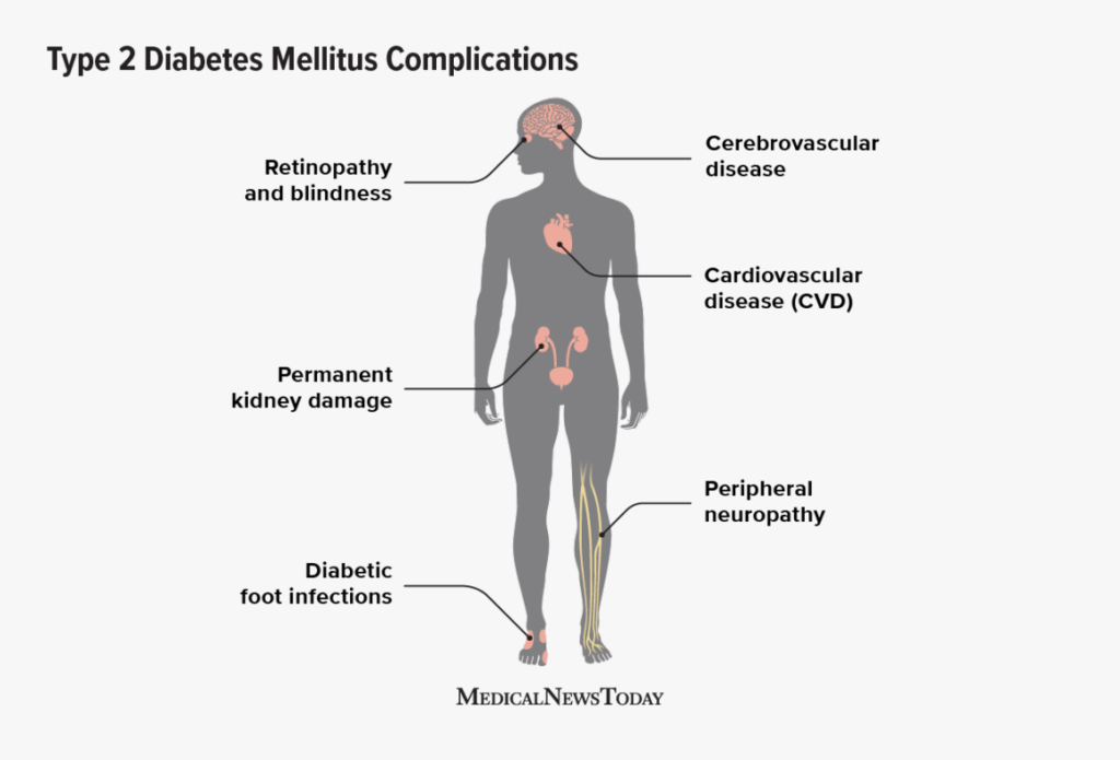 Potential Complications of Type 2 Diabetes